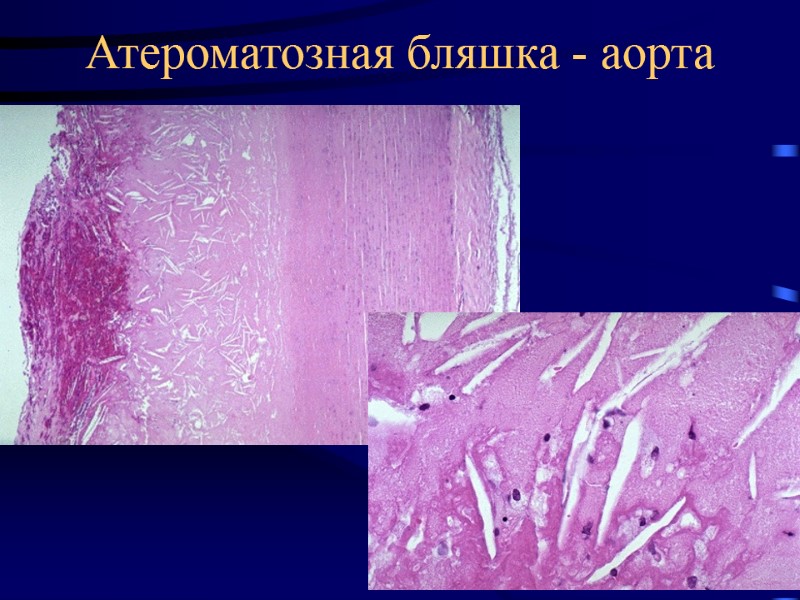 Атероматозная бляшка - аорта